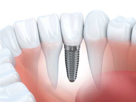 Natural-Looking Mini Implants Farmington Hills MI - Birmingham Center for Cosmetic Dentistry - dental_implants
