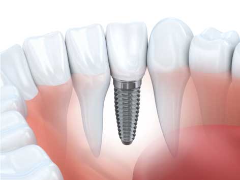  Dental Implants Troy MI - Birmingham Center for Cosmetic Dentistry - dental_implants