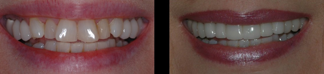 Teeth Whitening Farmington Hills MI - Birmingham Center for Cosmetic Dentistry - slider-6